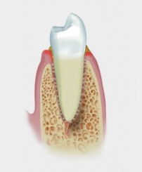 mild periodontitis