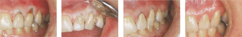 tooth coloured amalgam-free fillings