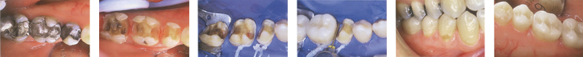 amalgam free fillings